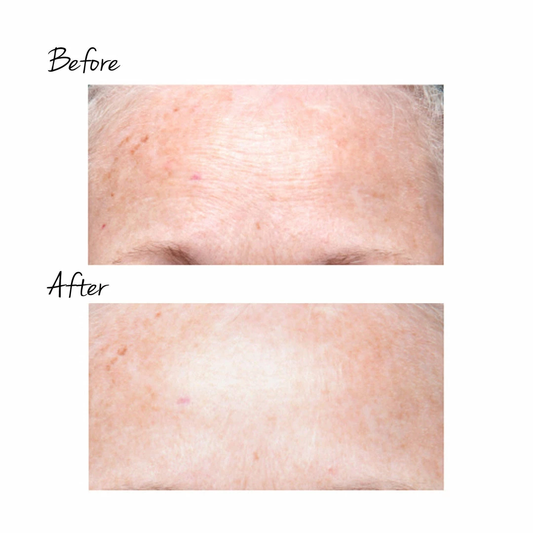 NuFACE Skin Care TRINITY WRINKLE REDUCER ATTACHMENT 3 NuFACE Skin Care TRINITY WRINKLE REDUCER ATTACHMENT